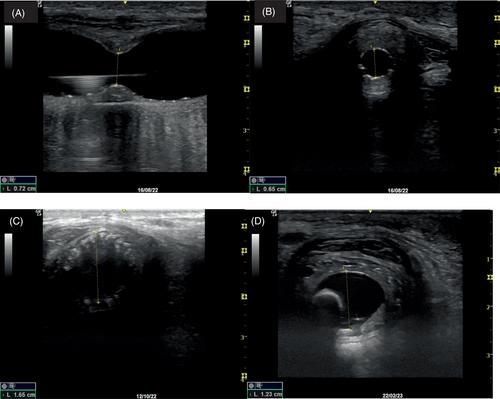 Treatment of a urethral stricture by image-guided placement of a custom-made absorbable stent in a standing, sedated horse