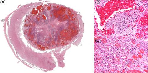 Malignant transformation of an intraparenchymal hemangioma in the cervical spinal cord of a German shepherd dog