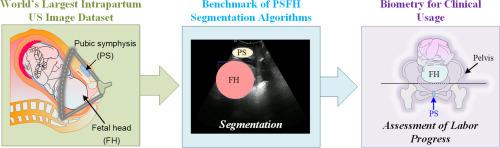 PSFHS challenge report: Pubic symphysis and fetal head segmentation from intrapartum ultrasound images