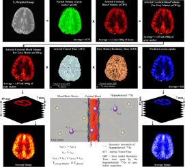 Measurement and modeling of xenon gas transfer in the human brain with 1H and hyperpolarized 129Xe MRI