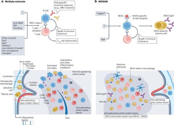 The influence of MOGAD on diagnosis of multiple sclerosis using MRI