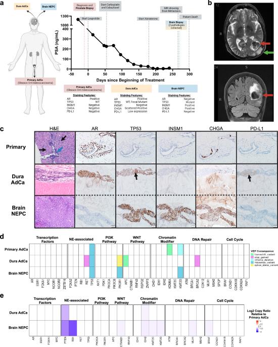 Integrated multi-omics assessment of lineage plasticity in a prostate cancer patient with brain and dural metastases