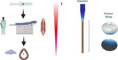 Multi-physics numerical simulation study on thermo-sensitive gel delivery for a local post-tumor surgery treatment