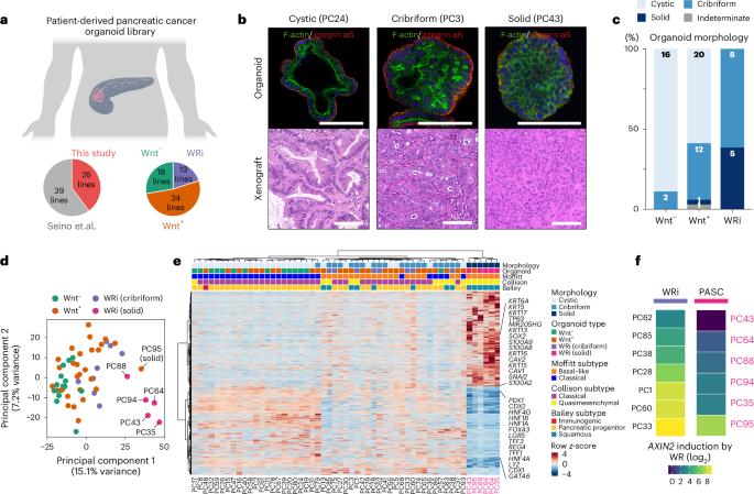 Wnt-deficient and hypoxic environment orchestrates squamous reprogramming of human pancreatic ductal adenocarcinoma