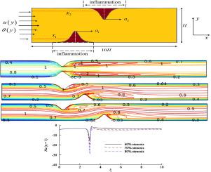 Computational investigations of nanofluid blood flow in stenosed artery with effects of inflammation and viscous dissipation via finite element method