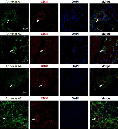 Comprehensive Proteomic Analysis of Dysferlinopathy Unveiling Molecular Mechanisms and Biomarkers Linked to Pathological Progression