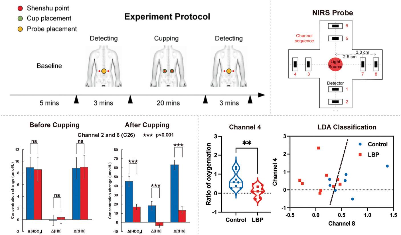 Noninvasive Assessing Low Back Pain by a Novel Near-Infrared Spectroscopy Flexible Probe With the Aid of Cupping Protocol