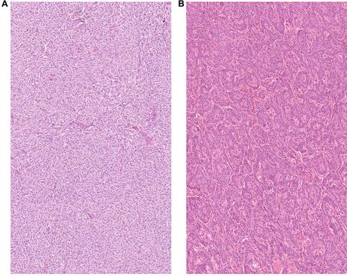 Genomic analysis defines distinct pancreatic and neuronal subtypes of lung carcinoid