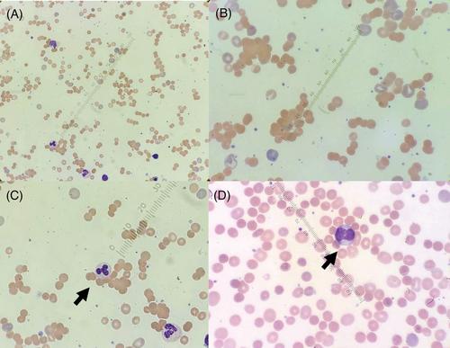 Mixed autoimmune hemolytic anemia as the initial presentation of systemic lupus erythematosus: A case report and review