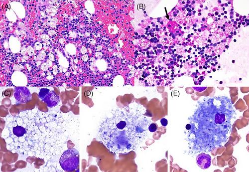 A diagnosis of non-neuronopathic and late-onset acid sphingomyelinase deficiency (Niemann-Pick disease A/B) following bone marrow biopsy showing foamy histiocytosis