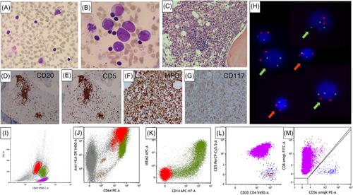 Concurrent hyperdiploid acute myeloid leukemia and trisomy 12+ chronic lymphocytic leukemia