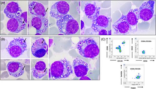 Neoplastic plasma cells with concomitant azurophilic crystalline inclusions and Snapper-Schneid bodies