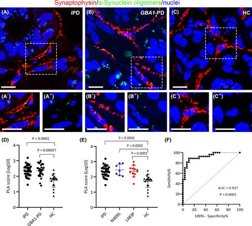 Comparing GBA1-Parkinson's disease and idiopathic Parkinson's disease: α-Synuclein oligomers and synaptic density as biomarkers in the skin biopsy