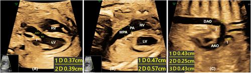 Aortic isthmus flow reversal in fetal coarctation of the aorta and the associated factors