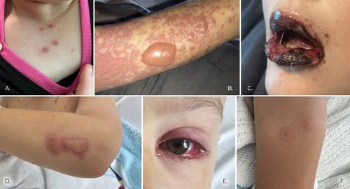 An outbreak of reactive infectious mucocutaneous eruption (RIME) after Mycoplasma pneumoniae infections in Sydney, 2024: retrospective case series