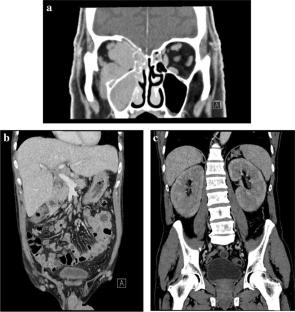 Rosai-Dorfman-Destombes disease in adults: a single center experience