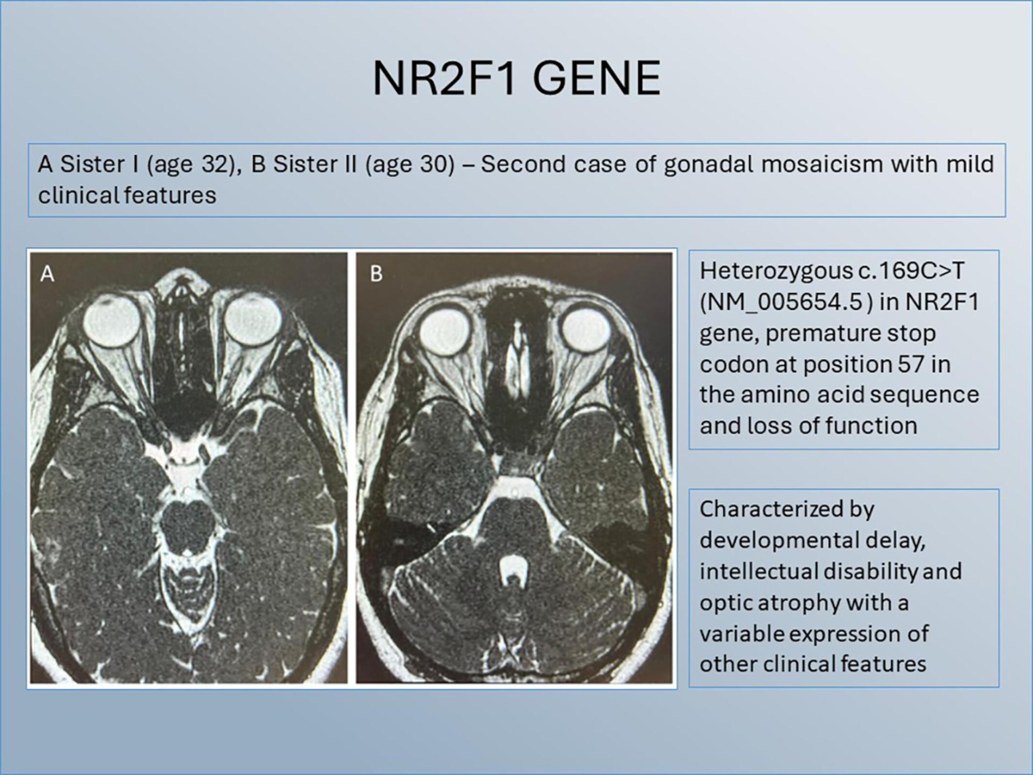 Second Case of Gonadal Mosaicism and a Novel Nonsense NR2F1 Gene Variant as the Cause of Bosch–Boonstra–Schaaf Optic Atrophy Syndrome