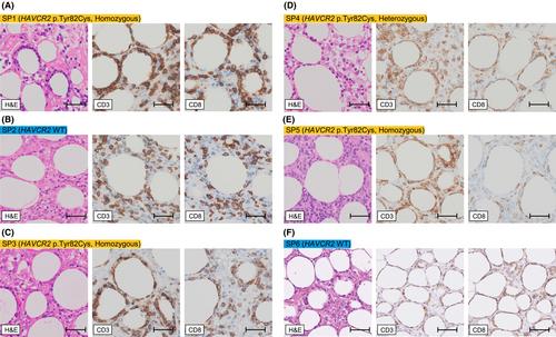 Genetic profiles and clinical features in subcutaneous panniculitis-like T-cell lymphomas