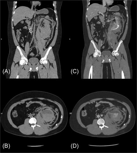 Selective embolization with autologous fat to treat massive bleeding secondary to percutaneous renal biopsy