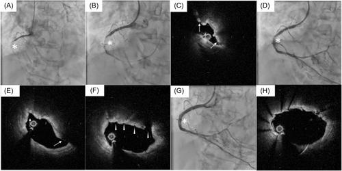 Methods for treating coronary eruptive calcified nodules