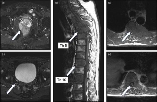 Severe neutropenia caused by palliative radiation therapy in a case of metastatic hormone-sensitive prostate cancer