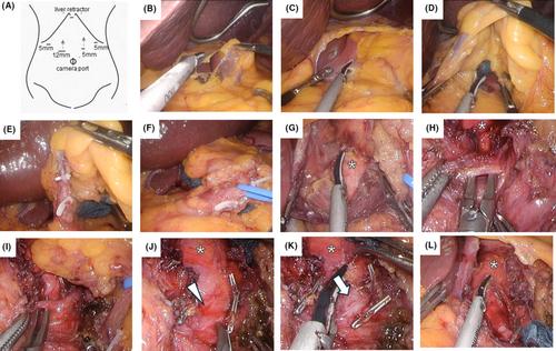 Laparoscopic median arcuate ligament release using an anterior approach for median arcuate ligament syndrome