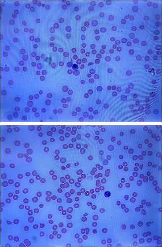 Thrombotic thrombocytopenic purpura masquerading as Evans syndrome