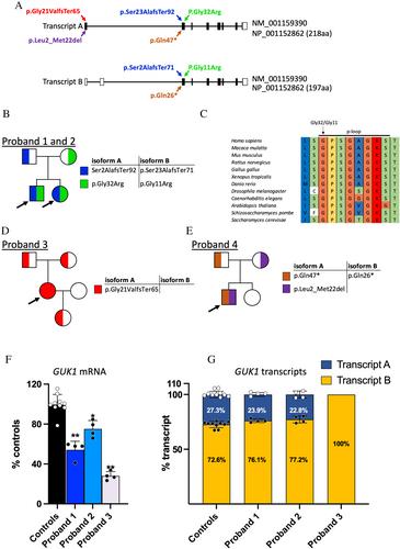 Guanylate Kinase 1 Deficiency: A Novel and Potentially Treatable Mitochondrial DNA Depletion/Deletions Disease