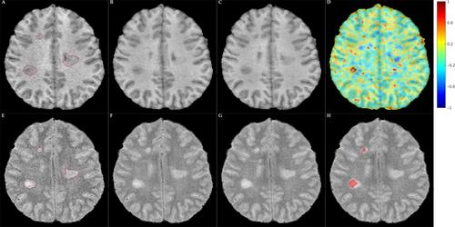 Slowly Expanding Lesions Differentiate Pediatric Multiple Sclerosis from Myelin Oligodendrocyte Glycoprotein Antibody Disease