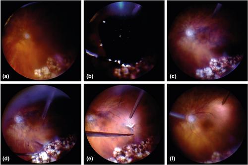 Vitreoschisis-induced vitreous cortex remnants in proliferative vitreoretinopathy: A comprehensive review from basic research to clinical practice