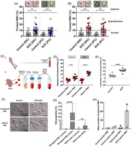 Clearance of pathogenic erythrocytes is maintained despite spleen dysfunction in children with sickle cell disease