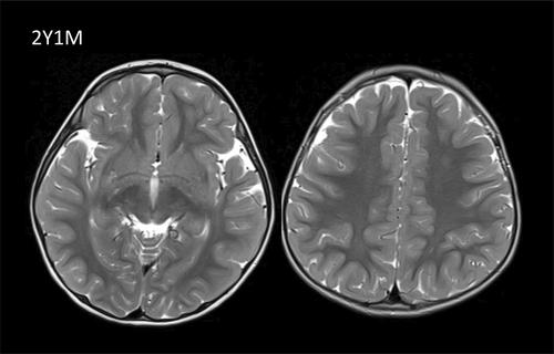Asymptomatic pediatric presentation of S-adenosylhomocysteine hydrolase deficiency
