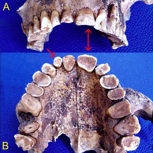 Double Teeth and Coexistent Anomalies: Examples From Continental Africa