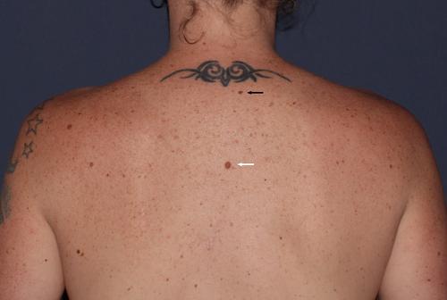 Melanoma documented arising in an involuting naevus 3 years after cessation of monitoring