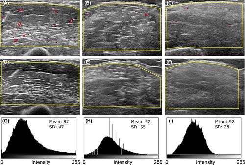 Muscular dystrophy patients show low exercise-induced blood flow in muscles with normal strength