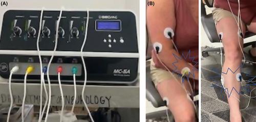 Scrambler therapy for treatment of poststroke pain.