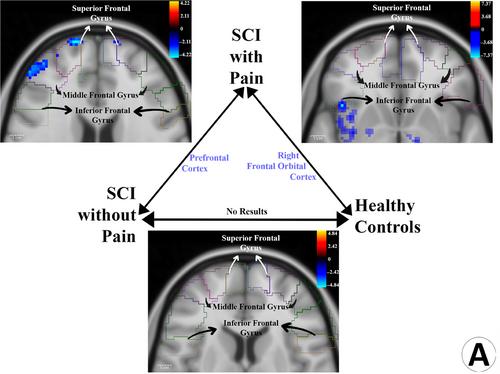 Periaqueductal gray connectivity in spinal cord injury-induced neuropathic pain