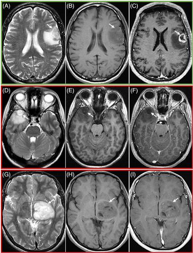 Human performance in predicting enhancement quality of gliomas using gadolinium-free MRI sequences