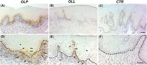 Expression of Programmed Death Ligand 1 and Indoleamine 2,3-Dioxygenase in Oral Lichen Planus and Oral Lichenoid Lesions