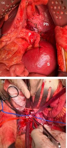 Patience is key for the surgeon in the management of a large haemorrhagic phaeochromocytoma with cardiomyopathy