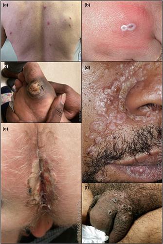 Mpox challenges in a clinical setting: patterns of skin lesions, diagnostic clues, and long-term consequences