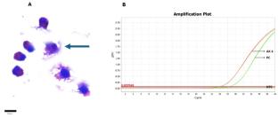 Dysesthesias and migratory myalgias: clinical clues to suspect neuroangiostrongyliasis