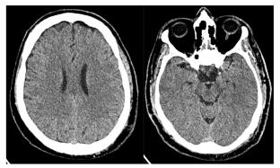 Encephalopathy with cerebellar deficits in a context of hyponatremia