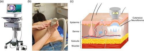 Protocol for high-intensity focused ultrasound (HIFU) treatment of cutaneous neurofibromas