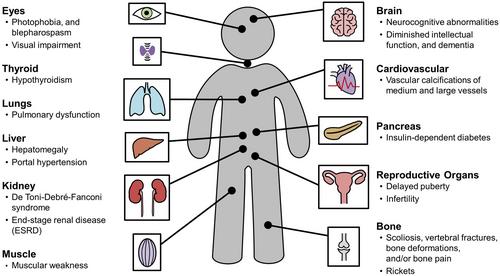 Liver Transplant From a Deceased Donor With Cystinosis: A Case Report
