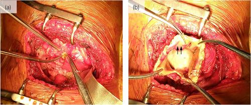A case of Page kidney due to an encapsulated perirenal hematoma improved by capsulectomy