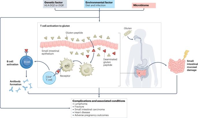 Coeliac disease: complications and comorbidities