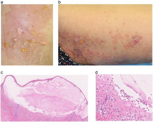 Prolonged Vancomycin-Induced Linear IgA Disease in a Patient With Renal Failure