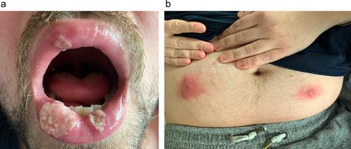 Refractory Pyostomatitis Vegetans With Multiple Aseptic Cutaneous Abscesses Successfully Treated With Filgotinib in Ulcerative Colitis