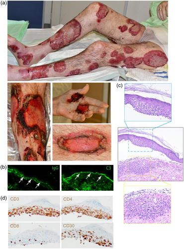 Emergence of bullous pemphigoid under treatment of mycosis fungoides with mogamulizumab